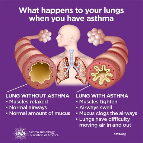 Asthma .